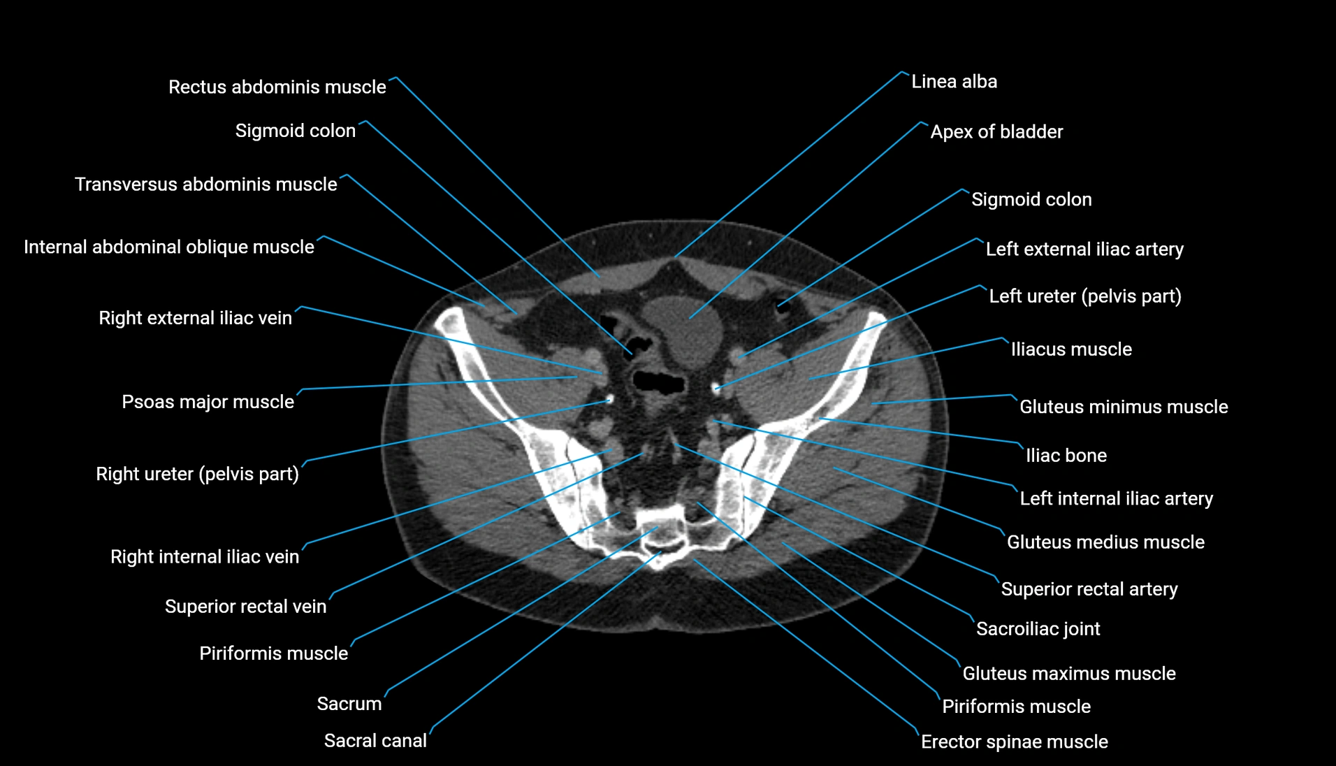 CT urogram axial cross sectional anatomy  labelled radiology image-00197.webp